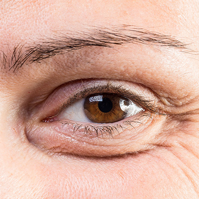 LASIK vision correction